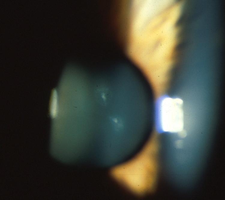 The lens cataracts
