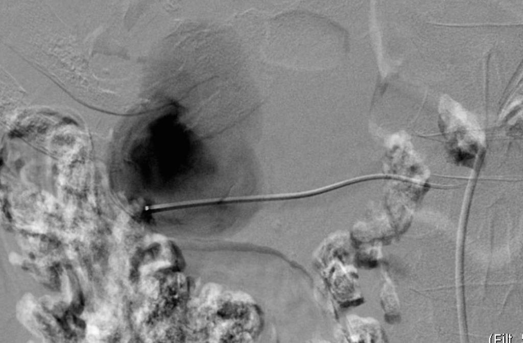 Intervention Mesenteric angiography with embolization Utilizing a