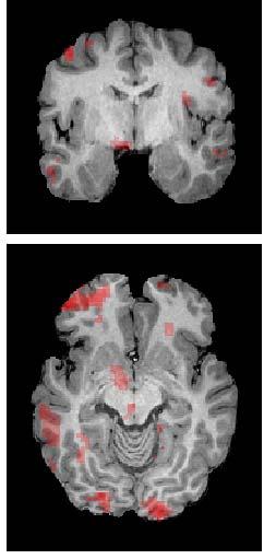 Hypothalamus Midbrain/PAG Cortical