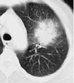 Treatment Success for Aspergillosis: Importance of Early CT and Early Therapy