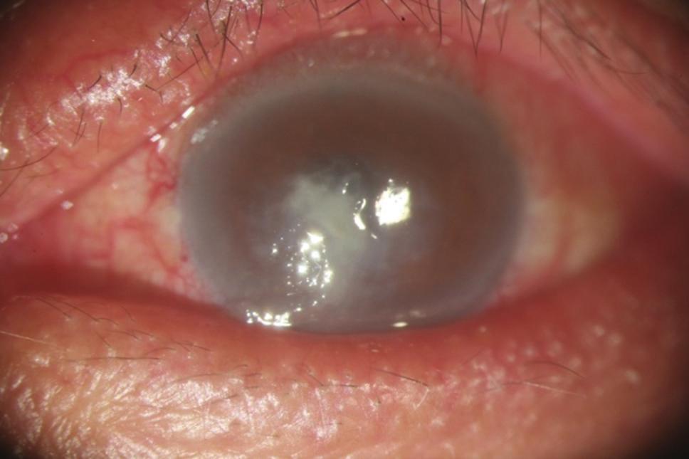 21 Gender, number of males (%) 17 (68%) 4 (57%) 0.32 Risk factor, number (%) Trauma 9 (36%) 5 (72%) 0.06 Preexisting corneal disease or surgery 10 (40%) 0 <0.001 Contact lens 4 (16%) 1 (14%) 0.