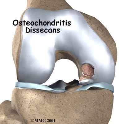 Osteochondritis Dissecans Introduction Osteochondritis dissecans (OCD) is a problem that affects the knee, mostly at the end of the big bone