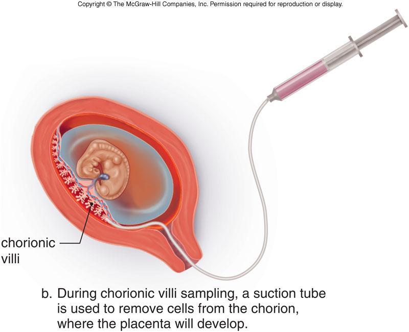 B. Chorionic villus sampling Tube through vagina into uterus