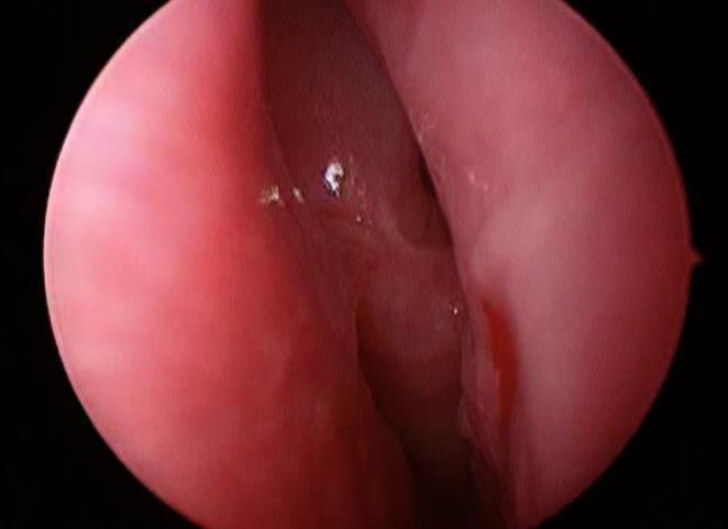 CRS without Nasal Polyps (CRSsNP)