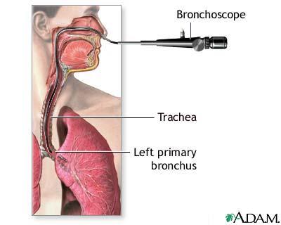 Bronchoscopy http://www.healthcentral.