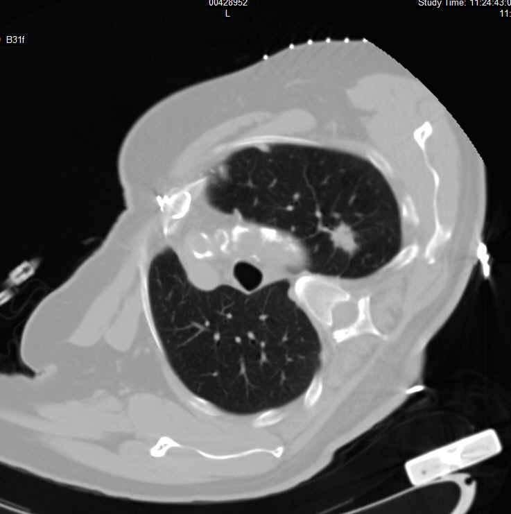 General Ablation Technique: CT guidance is used for ALL lung applications We use