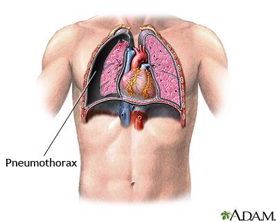 Immediate complications: Pneumothorax - a collapsed lung. A pneumothorax occurs when air leaks into the space between your lung and chest wall.