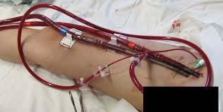 E-CPR E-CPR: ECMO assisted CPR Achieve ROC when we can t