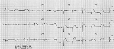 Case: LAD occlusion 55 male, s/p witnessed cardiac arrest.