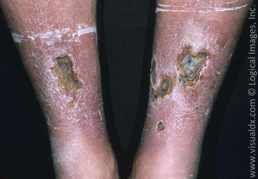 Stasis Stasis dermatitis-