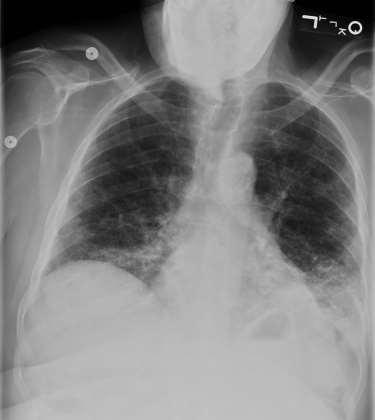 Opportunities for Antibiotic Stewardship Re-assess the need for antibiotics after 2-3 days CXR: common interpretation Cannot rule out infiltrate Need to