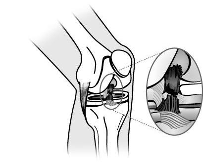 What is Anterior Cruciate Ligament (ACL) Repair? ACL stands for anterior cruciate ligament. ACL repair is surgery done to help lessen pain and swelling in your knee.