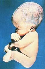 672 Unit Ten: Alterations in the Nervous System A B FIGURE 37-4 Congenital hydrocephalus.