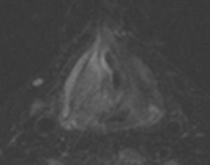 suppression Ax T2 MRI superior marrow