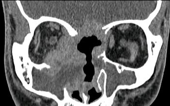 swelling Ax CT 