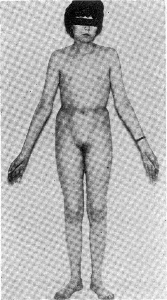The patients are of normal height, or tall, with absent secondary sexual development and primary amenorrhoea (Fig. 2).