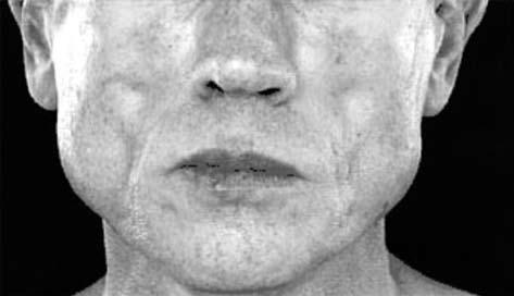 treatment complications in HIV Figure. Facial wasting. (Reprinted with permission from Carr A. Cooper DA. Images in clinical medicine. Lipodystropy associated with an HIV-protease inhibitor.