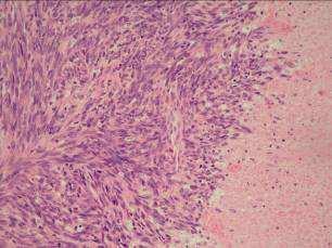 tumour cell necrosis vs.