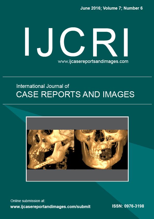 www.edoriumjournals.com CASE REPORT PEER REVIEWED OPEN ACCESS Calcified nodule as a cause of myocardial infarction with nonobstructive coronary artery disease Kaitlyn E.