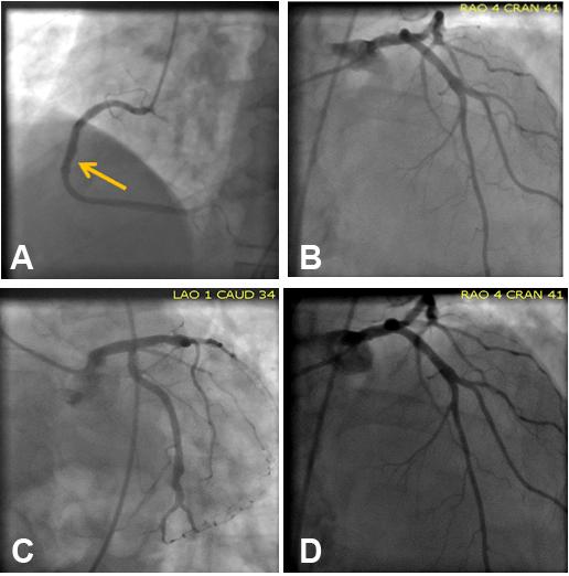 often reveals obstructive coronary artery disease (CAD) (defined as angiographic stenosis 50% in any major epicardial vessel).