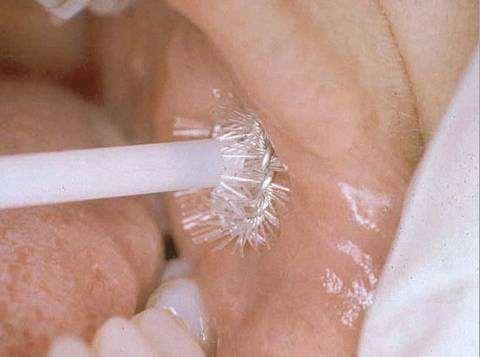 brush on lesion Apply firm pressure and rotate 5 to 10