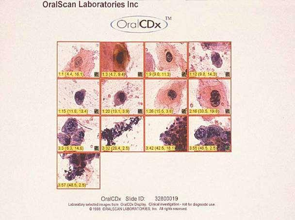 OralCDx Brush Biopsy Report Negative - no cellular abnormalities Positive epithelial dysplasia or