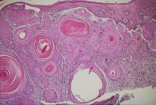 Oral Cancer Squamous Cell
