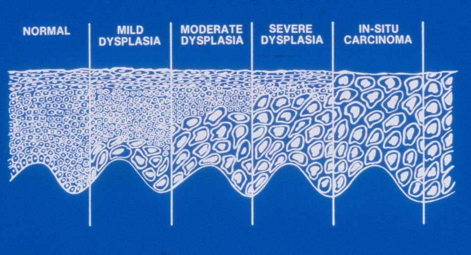 Grading Epithelial Dysplasia Mild - Lower 1/3 Moderate - Middle