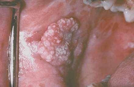 What Does Oral Squamous Cell Carcinoma Look Like Clinically?