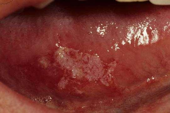 Endophytic Invasive Burrowing Ulcerated Leukoplakic a white