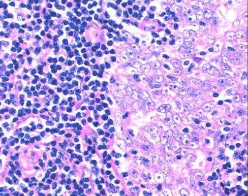 Histologic Grading of Squamous Cell Carcinoma Well