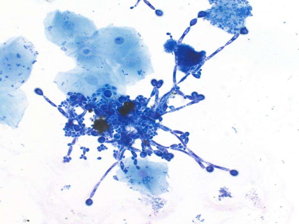 Oral Exfoliative Cytology for Diagnosis of