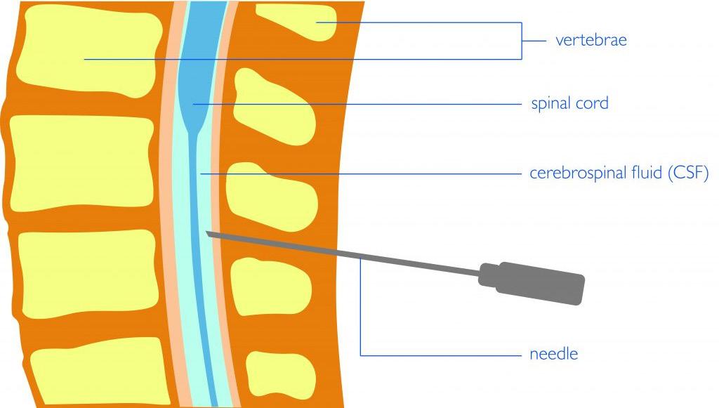 Lumbar puncture A diagram of a lumbar puncture A lumbar puncture is used to confirm the diagnosis of meningitis and to check for signs of what is causing it.