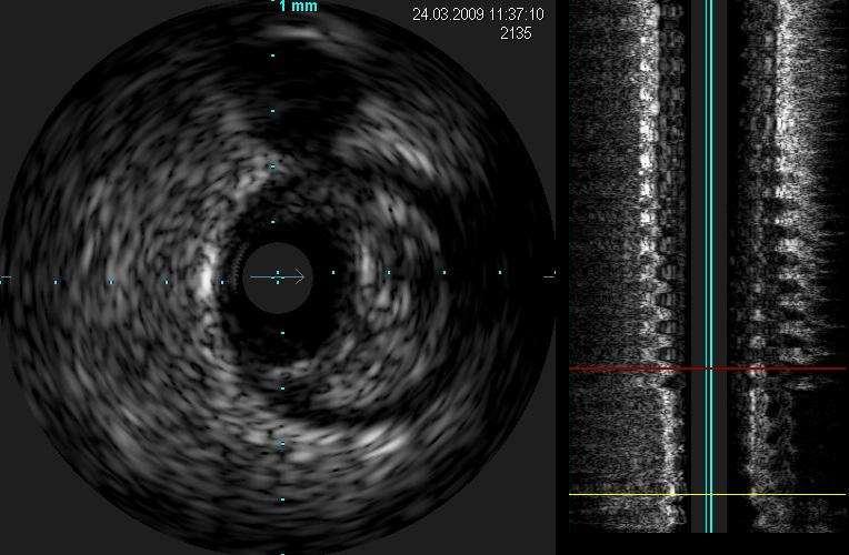 2 a Invasive Imaging/IVUS Grey Scale Stenosis