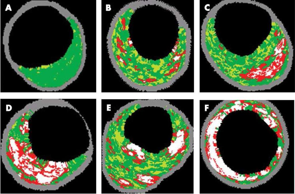 2 a Invasive Imaging/IVUS Plaque Characterization with IVUS-VH Intima