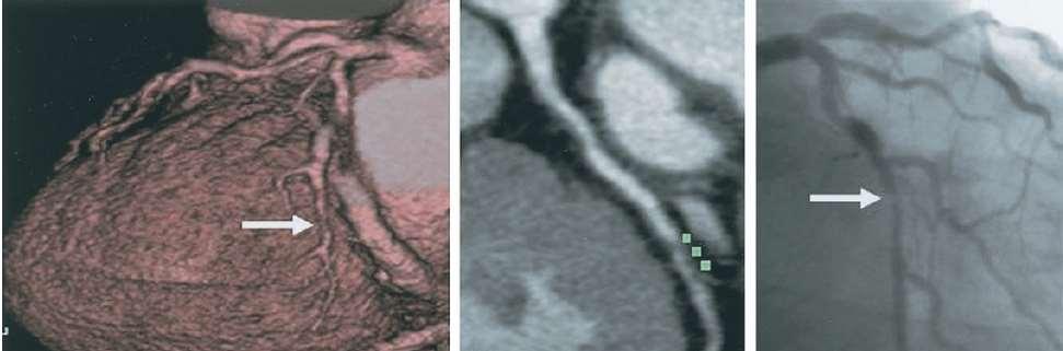 2b Non Invasive Imaging/MDCT Plaque Characterization ACS positive remodeling NCP