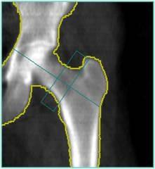 All of the ROIs are now appropriately identified. The GE femur scan in Fig. 31 has 1 corner of the femoral neck box that includes greater trochanteric bone.