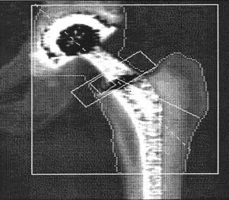 radiographer. In densitometry, artifacts and foreign objects are typically referred to as artifacts. Artifacts contained in DXA scans can create a number of obstacles for the densitometry operator.