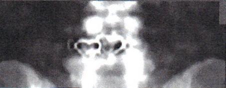 32 Artifacts found in the spine, femur, and forearm Utilize image contrast or invert the image and look for obvious light or dark spots. This will not affect BMD results.