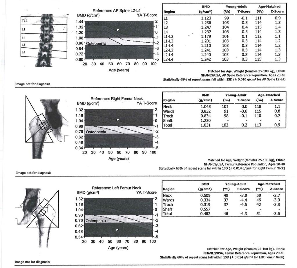 ISCD official positions state that the term osteopenia is retained, but low bone mass or low bone density is preferred. Fig. 8 GE Lunar Prodigy DXA report Fig.