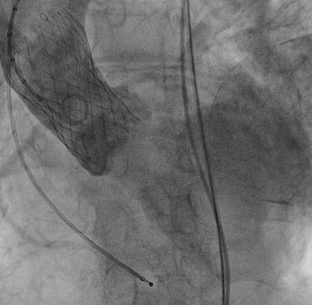 Aortic regurgitation A degree of paravalvular leak (PVL) following TAVI is common, much more common than SAVR.