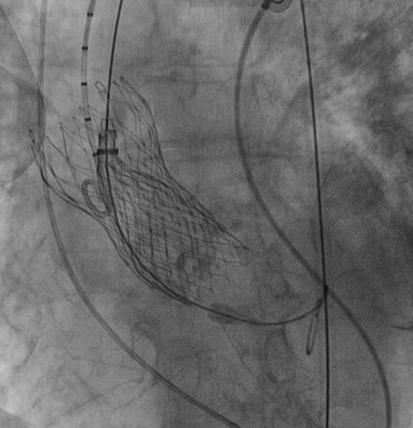 Central transvalvular aortic regurgitation (AR) is rare but may be due to leaflet malfunction secondary to damage during the crimping process or post dilatation.