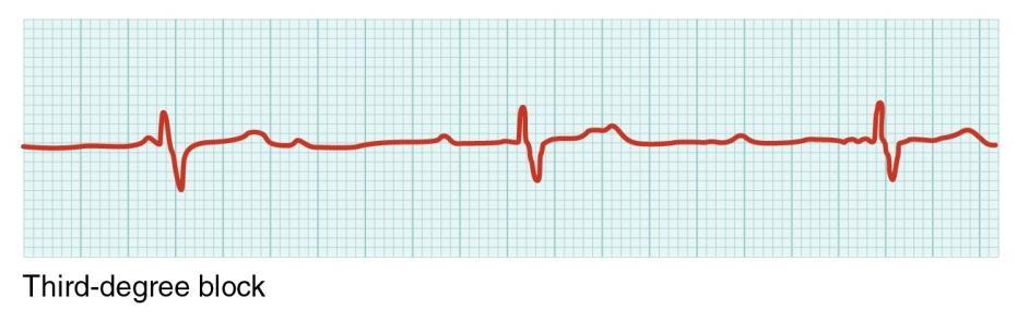 Figure 6 ECG waveform of third-degree heart block Source: cnx.