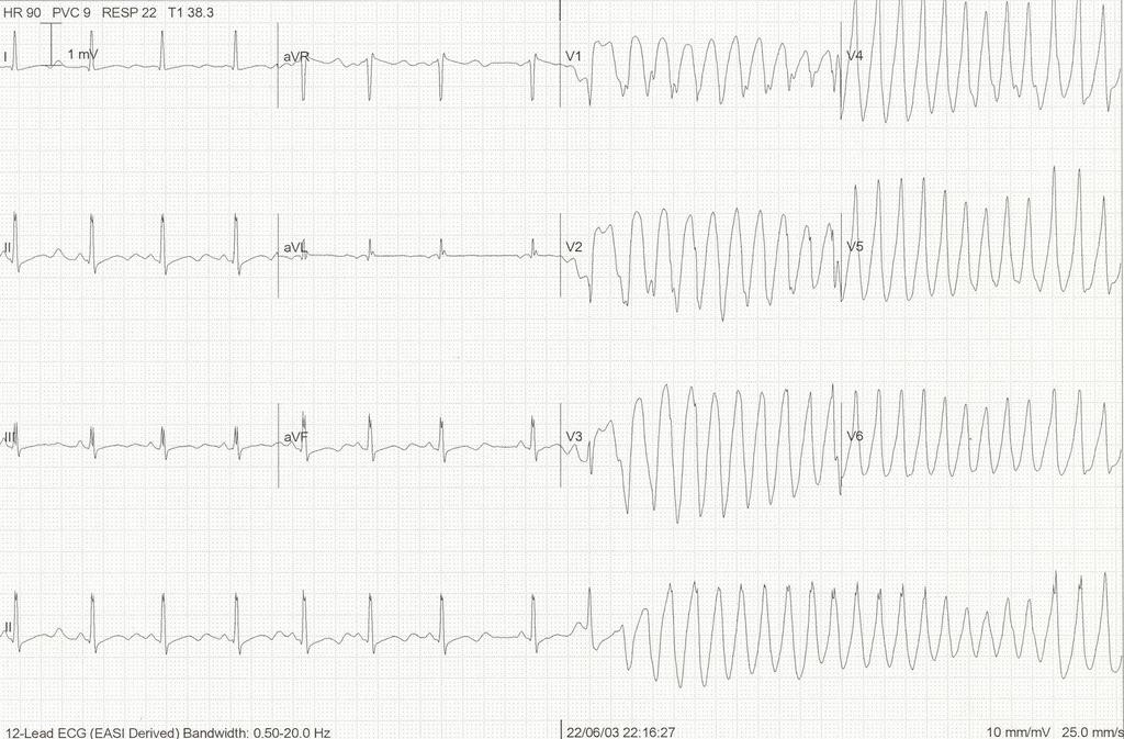 Supraventricular arrhythmias, such as atrial flutter/fibrillation or SVT may also occur but are clearly less severe.