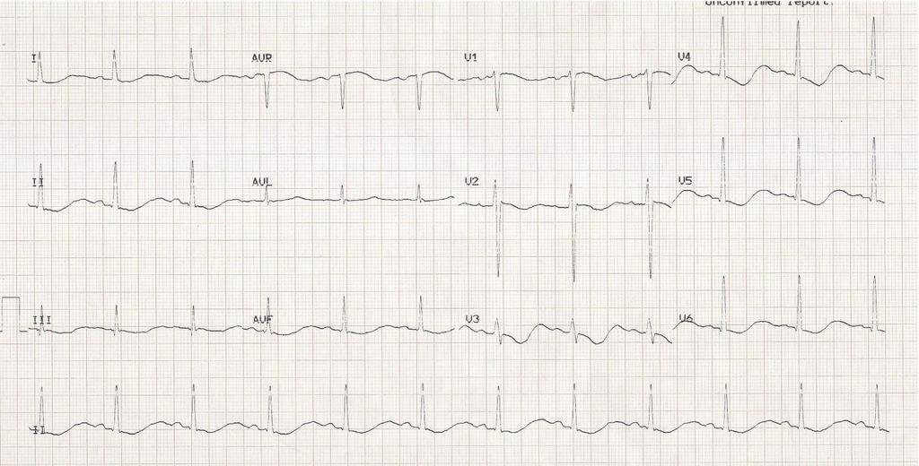 In the patient with a milder hyperkalaemia, were more subtle signs may be seen on the ECG, what to look for is increased amplitude and length of the P-wave, as the
