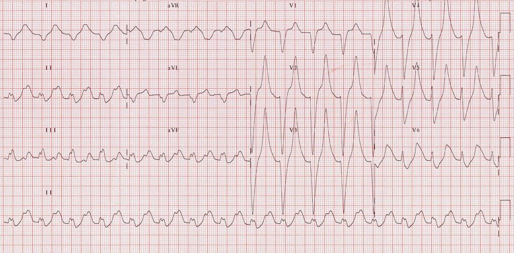 Perhaps the earliest sign of hyperkalaemia is peaked T-waves. In hypokalaemia the atria became hyperexcitable, giving us high and wide P-waves.