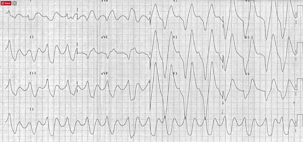 The interval of the QRS-complexes can thus become prolonged as a result of lowered stimulus from the atria.