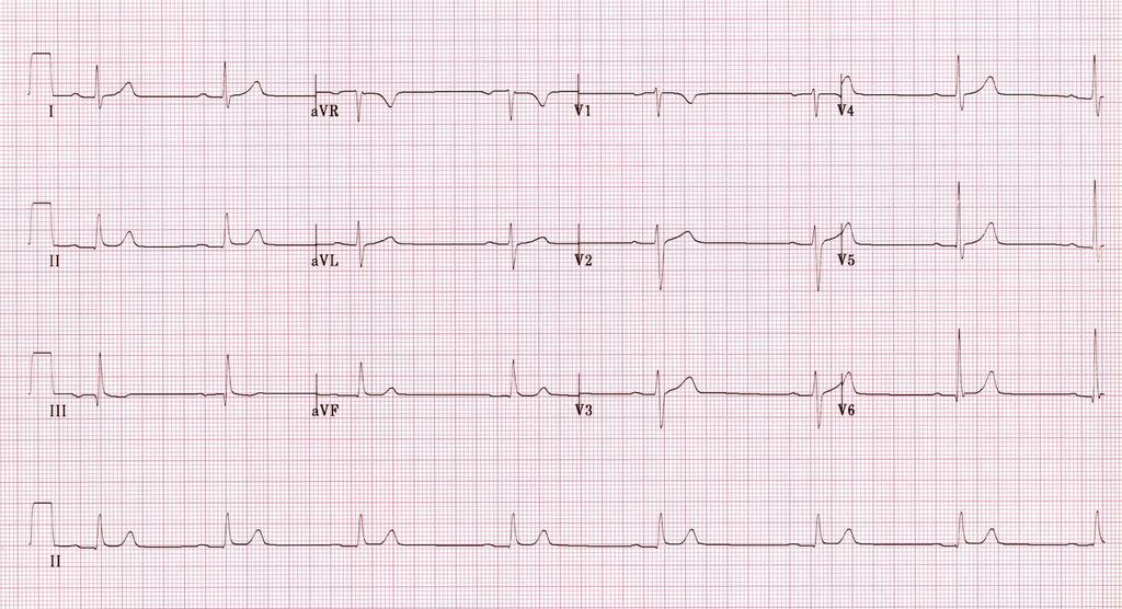 Medicine toxicity Beta blockers and Calcium channel blockers Beta blocker and heart selective calcium channel blocker (such as verapamil and diltiazem) toxicity shows up on the ECG as sinus or