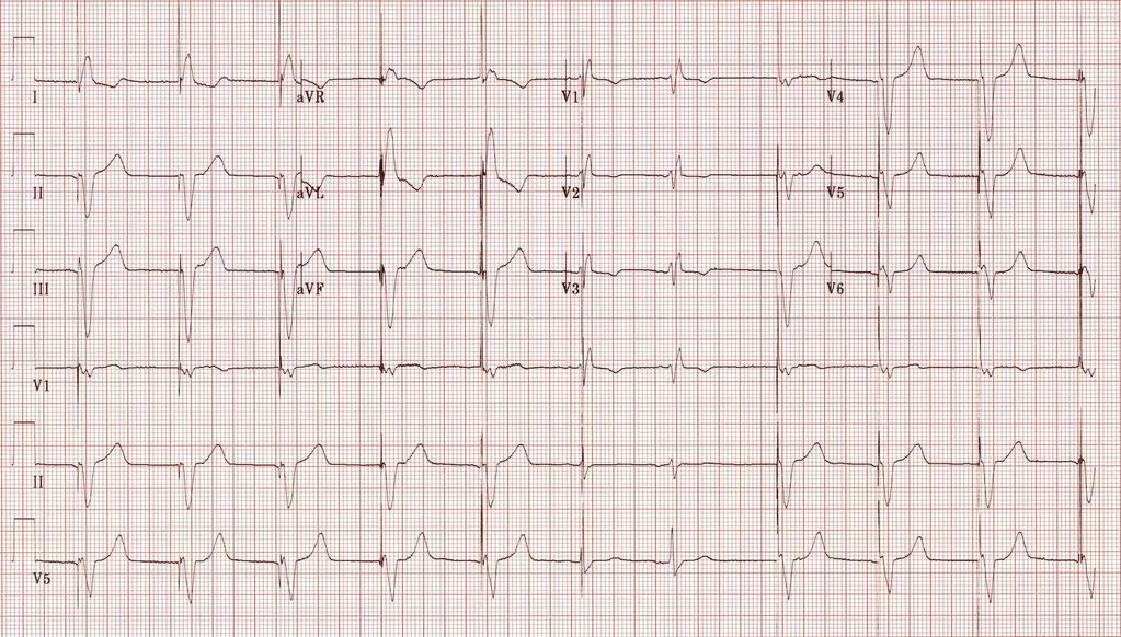 Pacemaker basics A pacemaker can work in many different ways depending on where it senses, where it paces and what response it has to the sensed sites.