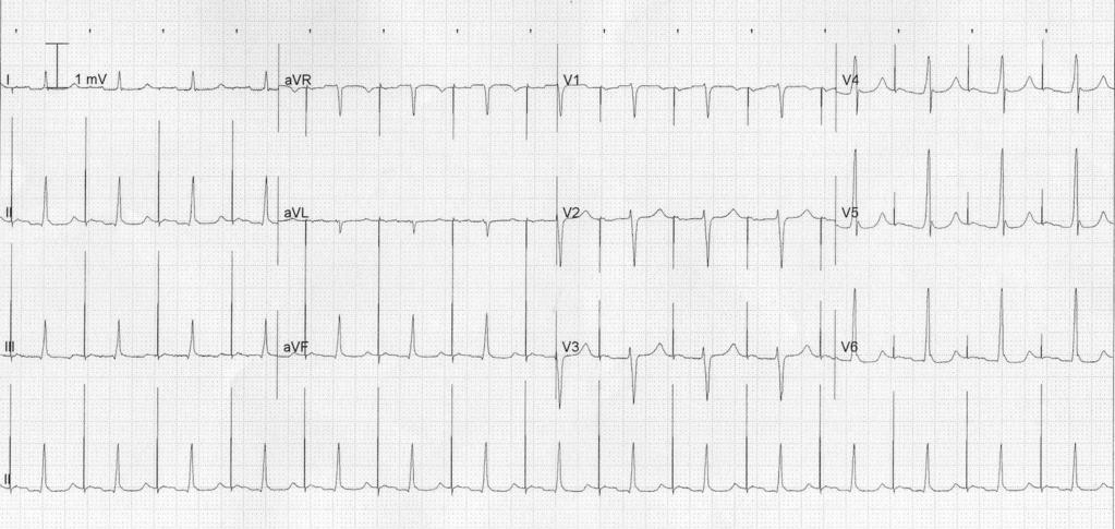 Pacemaker basics Above we see an ECG with a pacing spike just before the P-wave, thus an atrial pacing.